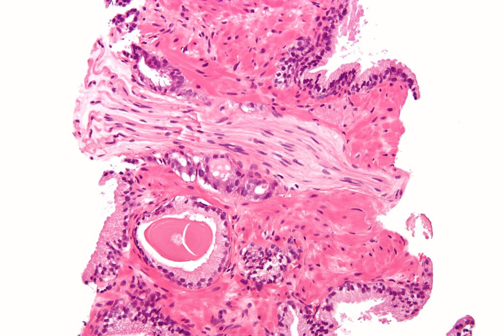 Image: Micrograph showing a prostate cancer (conventional adenocarcinoma) with perineural invasion (Photo courtesy of Wikimedia Commons)